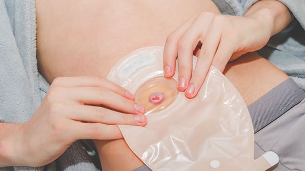 Cuidados de ostomías a domicilio en Granada por enfermero colegiado